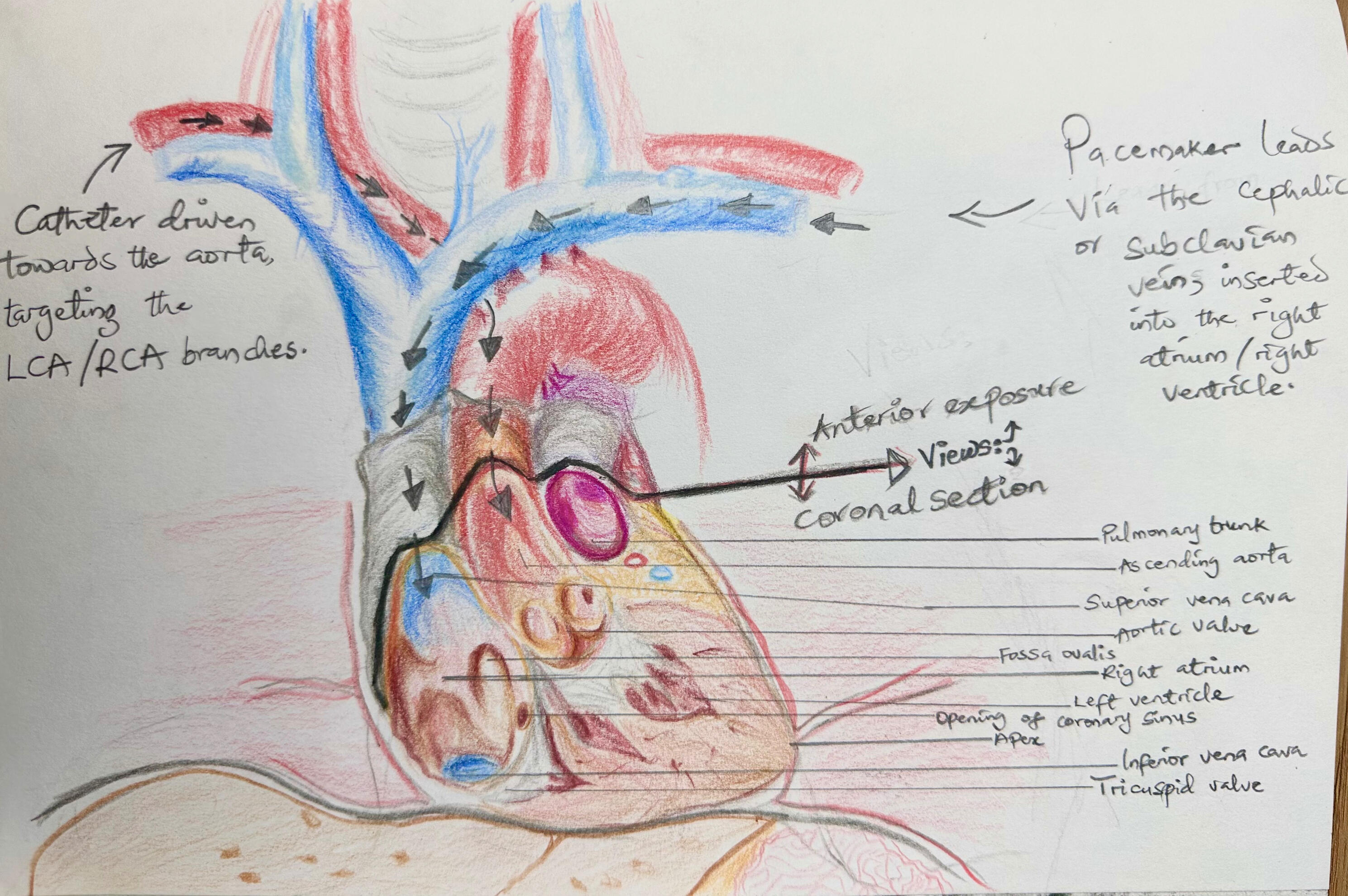 Anterior + Coronal View of the Heart for Angio & Pacing | 2025: A visual on the different pathways between procedures for a pacemaker insertion Vs an angiography/angioplasty/stenting.